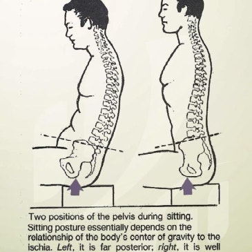 Scoliosis — problem