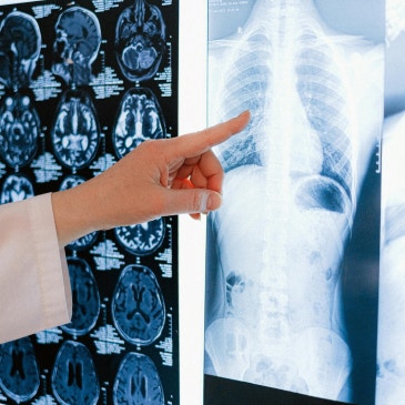 Forward head posture — problem